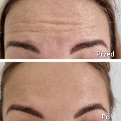 Wrinkle removal