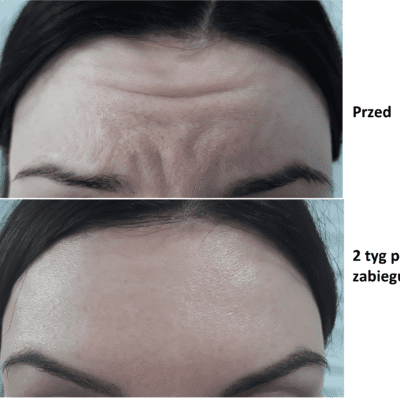 Wrinkle removal