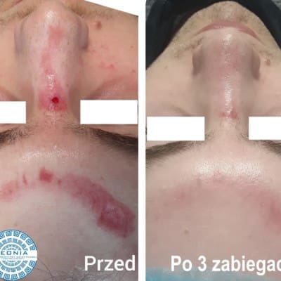 Scar removal