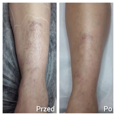 Spider veins removal