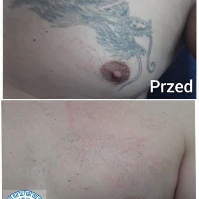 Tatto removal