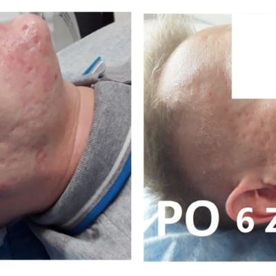 Acne scar removal