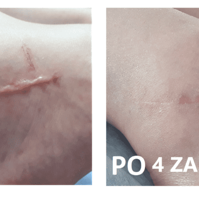 Scar removal