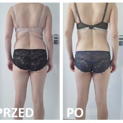 Cryolipolysis