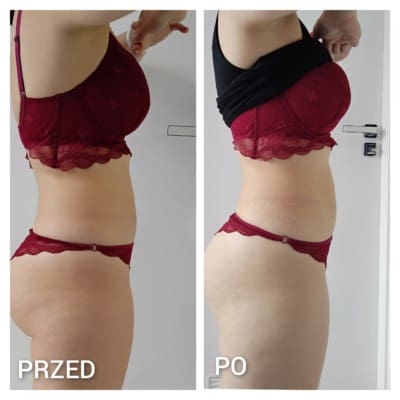 Cryolipolysis
