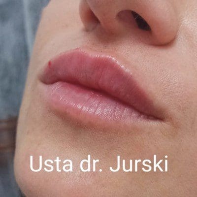 Lip Fillers
