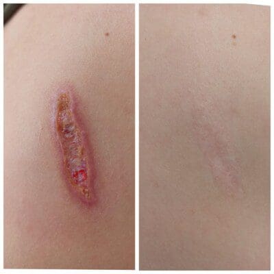 Scars