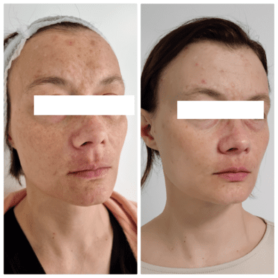 Hyperpigmentation