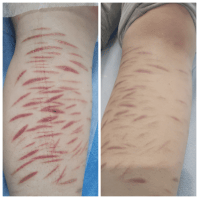 Scars