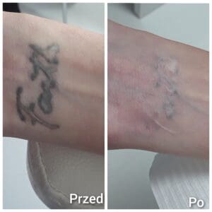 Laserowe usuwanie tatuażu efekty
