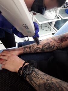 Usuwanie tatuażu pod cover w Krakowie